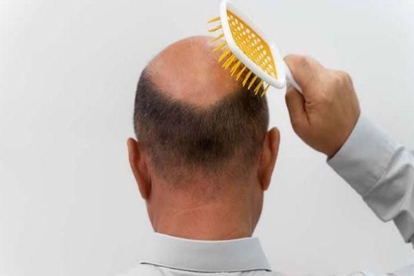 شانه زدن بعد از کاشت مو