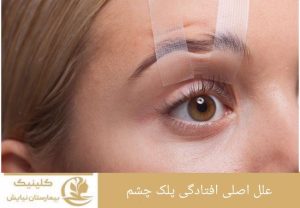 علل اصلی افتادگی پلک چشم