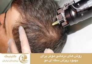 روش های درمانی موثر برای بهبود ریزش سکه ای مو