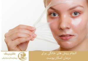 انجام روش‌های خانگی برای درمان اسکار پوست