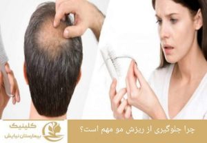 چرا جلوگیری از ریزش مو مهم است؟