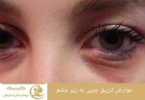 عوارض تزریق چربی به زیر چشم