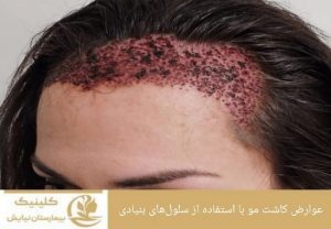 عوارض کاشت مو با استفاده از سلول‌های بنیادی