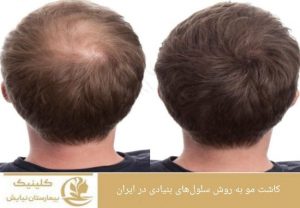 کاشت مو و روش سلول‌های بنیادی در ایران