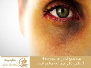 علت شایع کبودی زیر چشم بعد از کربوکسی تراپی شامل چه مواردی است؟