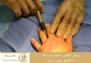درمان کاهش حجم دست ها با تزریق چربی و ژل
