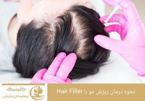 نحوه درمان ریزش مو با Hair Filler