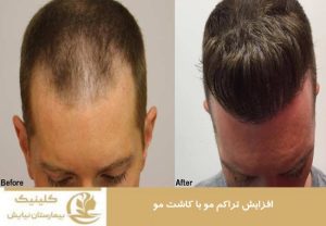 افزایش تراکم مو با کاشت مو