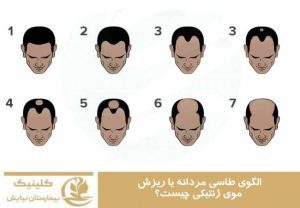 الگوی طاسی مردانه یا ریزش موی ژنتیکی چیست؟