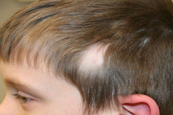 علت ریزش مو و کچلی در کودکان