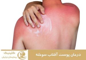 درمان پوست آفتاب سوخته