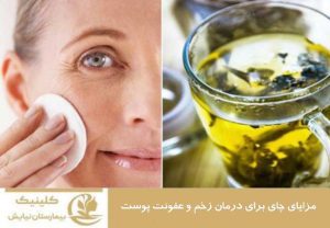 مزایای چای برای درمان زخم و عفونت پوست