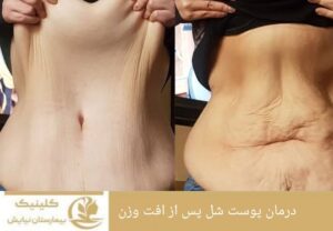 درمان پوست شل پس از افت وزن
