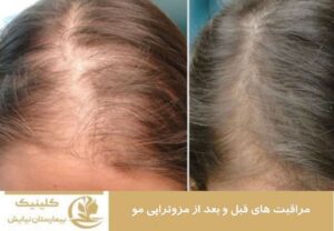 مراقبت های قبل و بعد از مزوتراپی مو