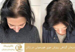 درمان گیاهی ریزش موی هورمونی در زنان