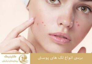 بررسی انواع لک‌های پوستی