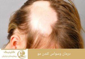  درمان وسواس کندن مو