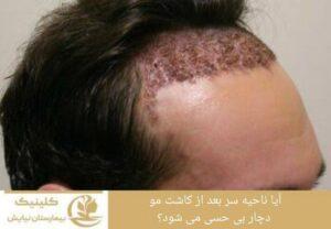 آیا ناحیه سر بعد از کاشت مو دچار بی حسی می شود؟