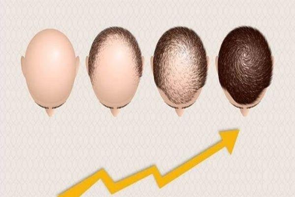 پروسه بهبود مو پس از کاشت