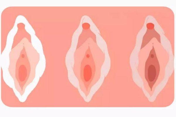 افزایش شفافیت واژن