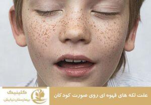 علت لکه های قهوه ای روی صورت کودکان