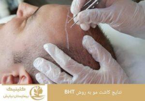 نتایج کاشت مو به روش BHT