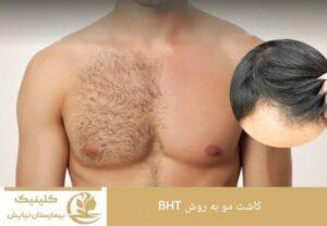 کاشت مو به روش BHT