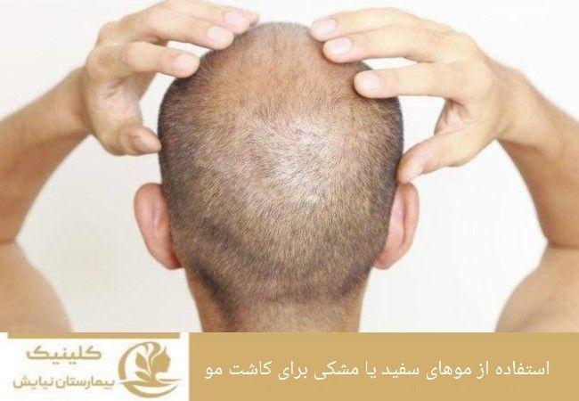 روشهای استفاده از موهای سفید و مشکی در کاشت مو
