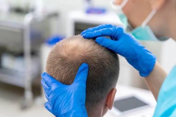 کاشت مو ژنتیک چیست