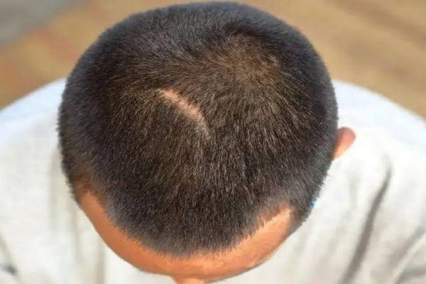 کاشت مو در جای شکستگی سر امکان‌پذیر است؟