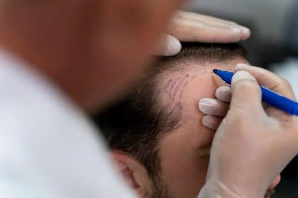 کاشت مو برای بیماران هپاتیتی