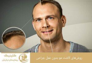 روش‌های کاشت مو بدون عمل جراحی