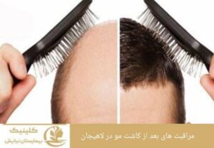 مراقبت های بعد از کاشت مو در لاهیجان