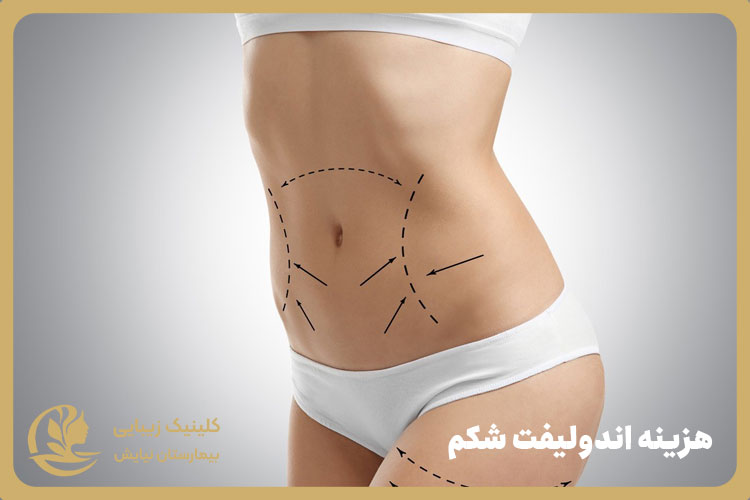 هزینه اندولیفت شکم