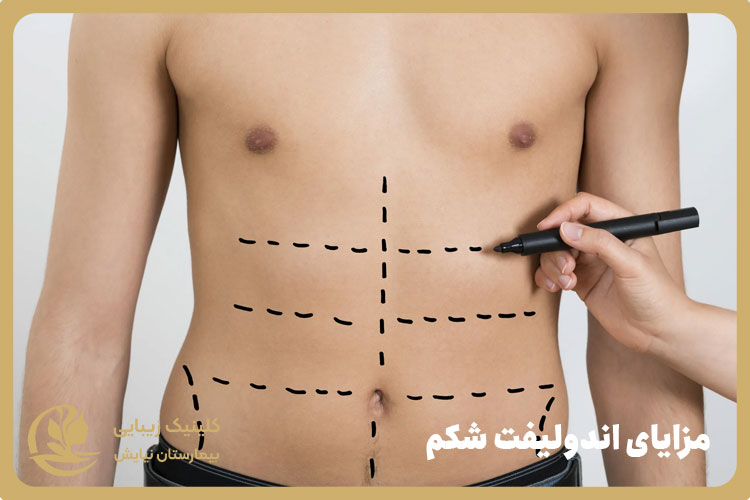 مزایای اندولیفت شکم