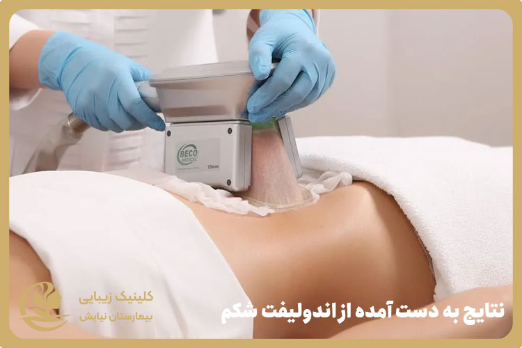 نتایج به دست آمده از اندولیفت شکم