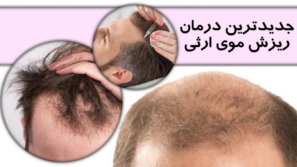 جدیدترین درمان ریزش موی ارثی