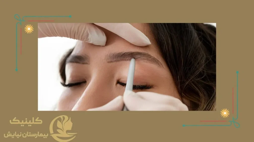 کاشت ابرو بدون جراحی